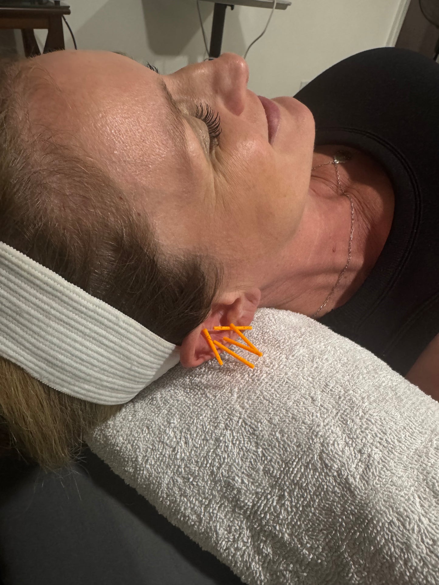 Auricular Acupuncture Session