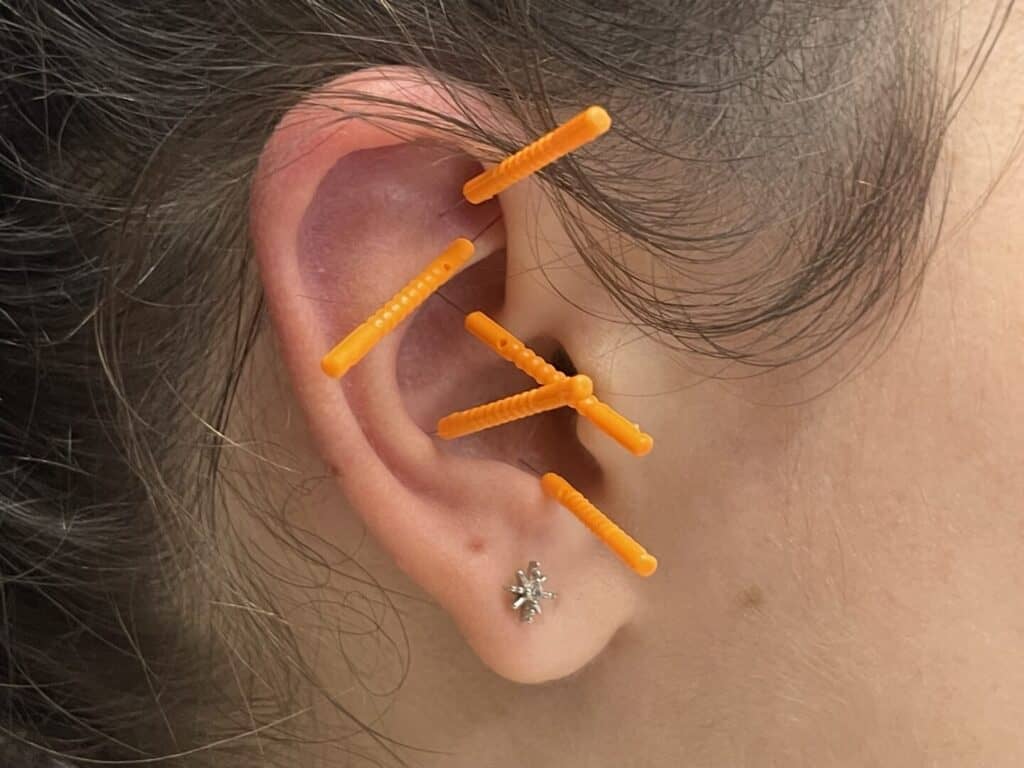 Auricular Acupuncture Session